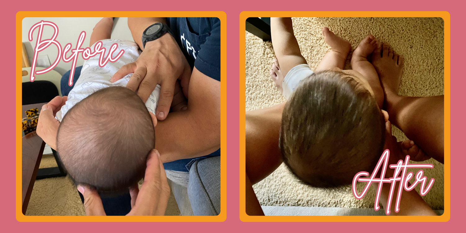 Before and after pediatric physical therapy- plagiocephaly