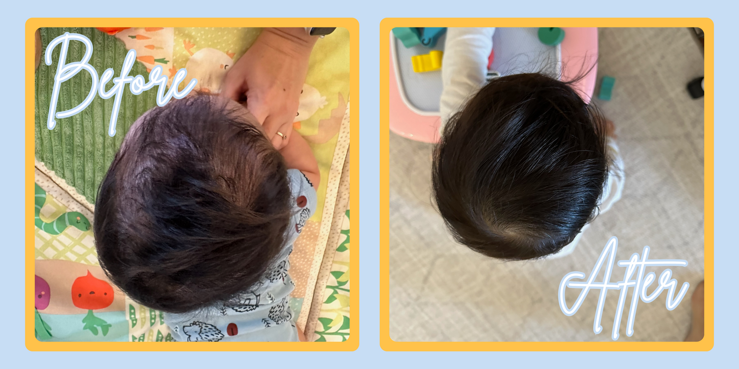 Before and after pediatric physical therapy- plagiocephaly 1